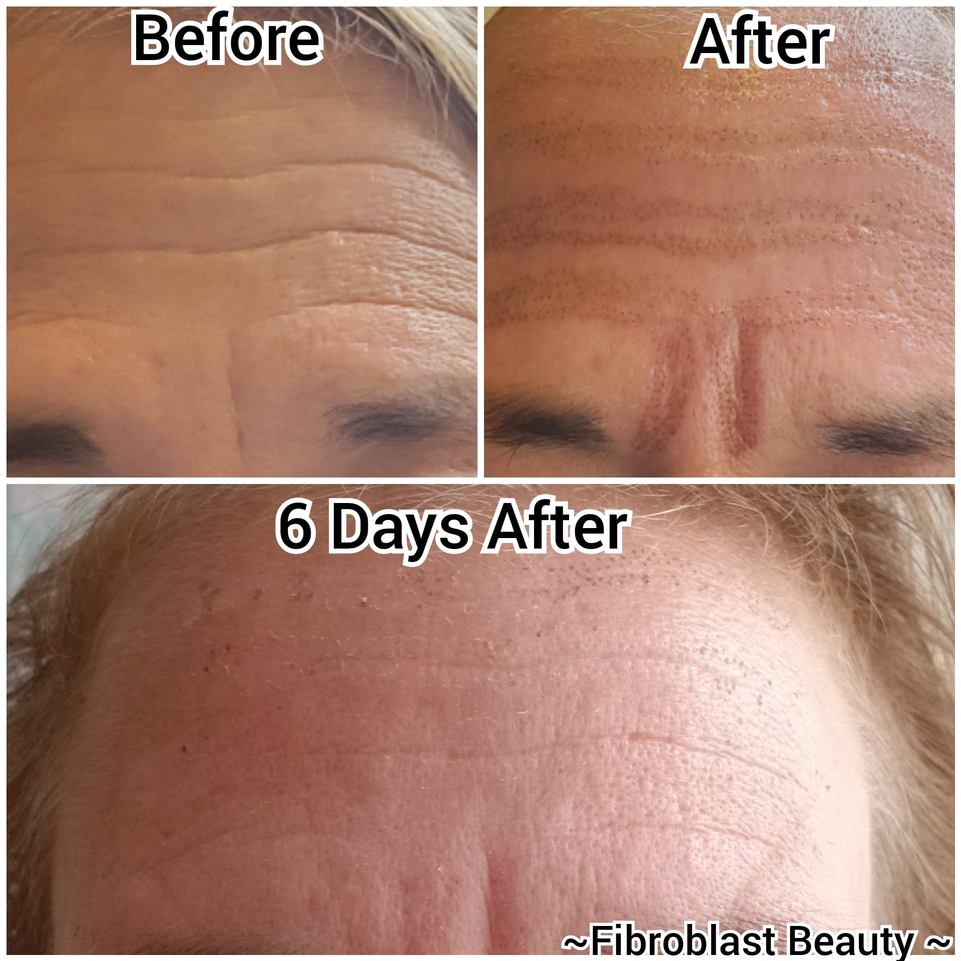 plasma fibroblast before and after